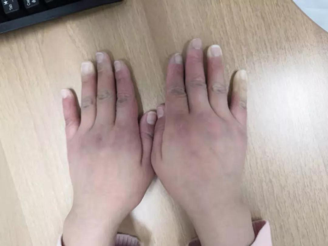 “手指、腳趾發(fā)白、發(fā)紫……”這些“小毛病”千萬別大意