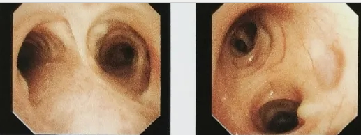 西安國際醫(yī)學中心醫(yī)院成功開展首例鞘管引導的經(jīng)支氣管鏡冷凍肺活檢術GS-TBLC