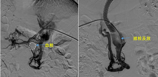 血栓攔路，如何破局——罕見(jiàn)巨大門(mén)靜脈血栓TIPS手術(shù)實(shí)錄