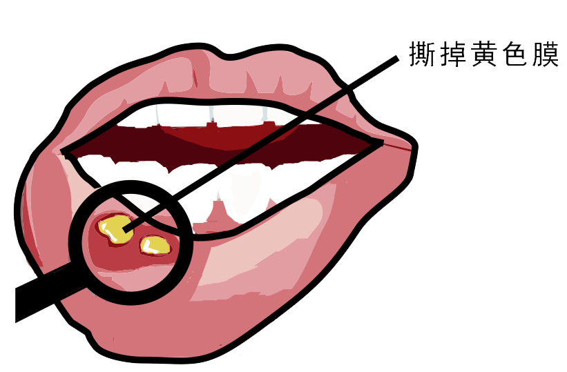 經(jīng)?？谇粷儯娴闹皇侨本S生素嗎？