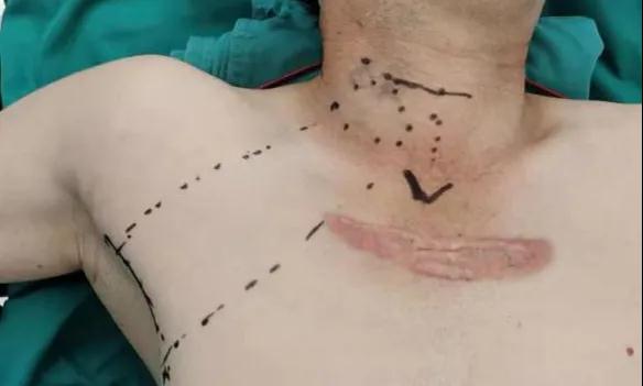 術(shù)后傷口可以“隱身”嗎？