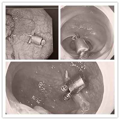 消化病醫(yī)院內(nèi)外科聯(lián)合開展3例“磁環(huán)預標記輔助腹腔鏡結、直腸癌根治術”