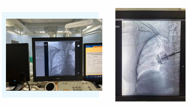醫(yī)護攜手為患者打造“隱形生命線”——我院完成上臂港植入術