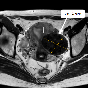 保子宮、保留生育功能—磁波刀治療子宮肌瘤