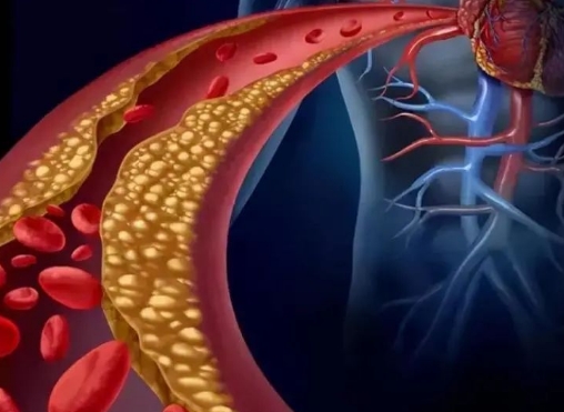 警惕！冠脈支架術(shù)后這些誤區(qū)千萬(wàn)別踩，趕緊收藏！