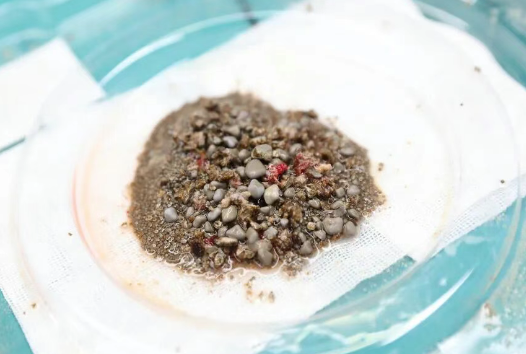 密集恐懼癥慎入！男子腎臟里取出上萬(wàn)顆沙石